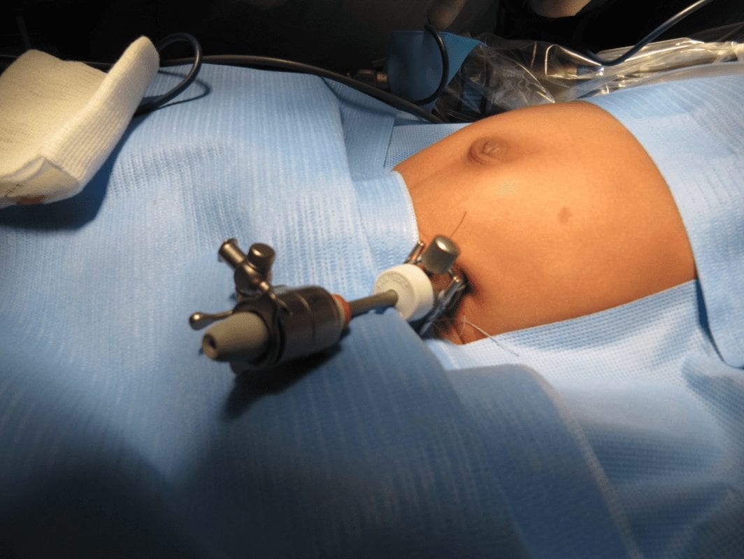 You are currently viewing What Is ‘Minimally Invasive Paediatric Surgery’ (MIS)?