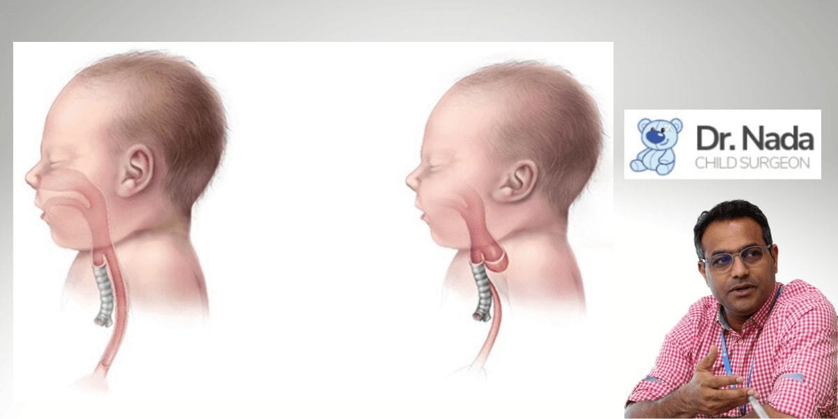 Read more about the article What is Oesophageal Atresia and how to treat it in Malaysia