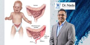 Read more about the article Hirschsprung disease – causes, symptoms & treatment in Malaysia