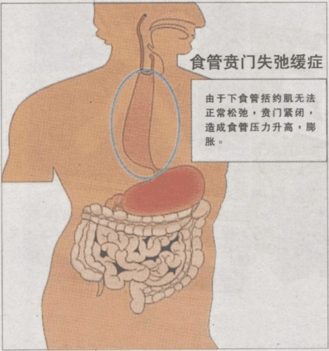 Symptoms of Oesophageal Achalasia