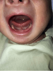 Tongue Tie Malaysia