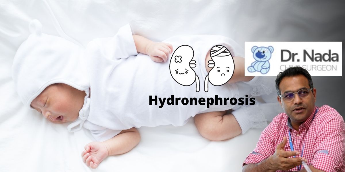 Read more about the article Hydronephrosis in babies and children – symptoms, causes & treatment in Malaysia