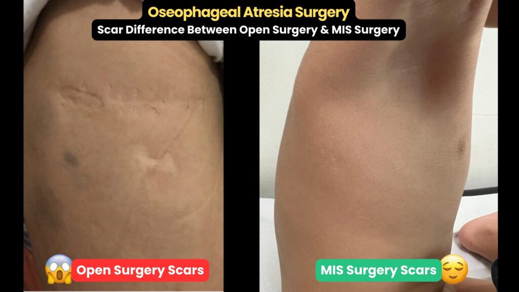 Oseophageal Atresia-Scar Comparison Open vs MIS