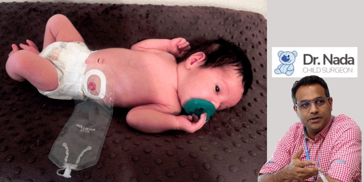 Read more about the article Anorectal Malformation in children – causes, symptoms & treatment in Malaysia