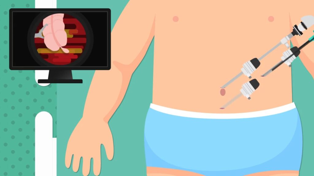 Pediatric Appendicitis Surgery